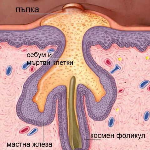 Акне