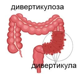 Дивертикулоза, дивертикулит - снимка 2