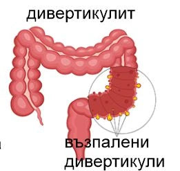 Дивертикулоза, дивертикулит - снимка 3
