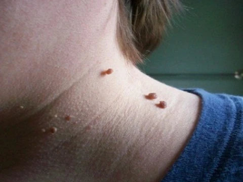 Неприятните кожни израстъци
