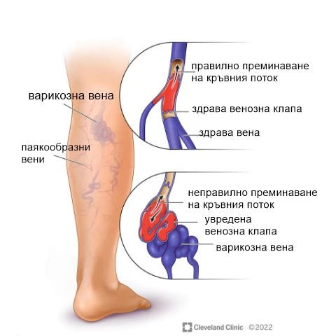 Разширени вени